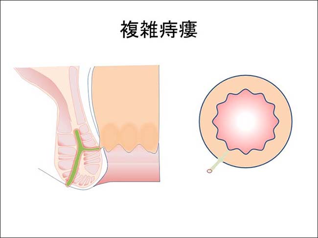 痔ろう