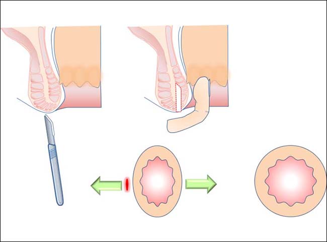 切れ痔