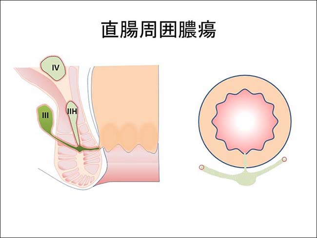 痔ろう