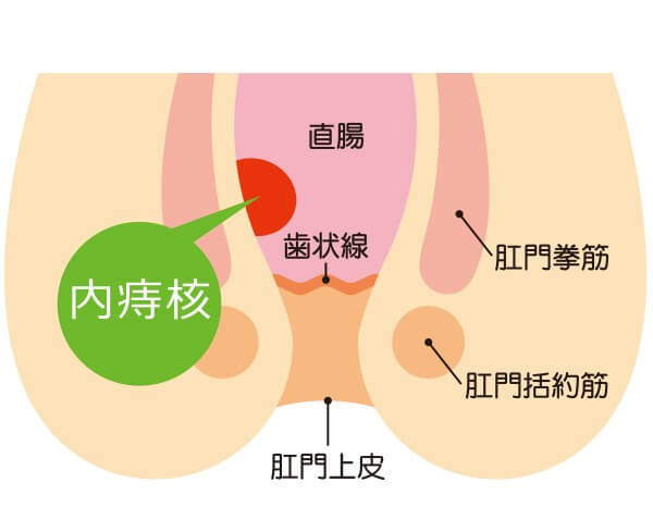 いぼ痔